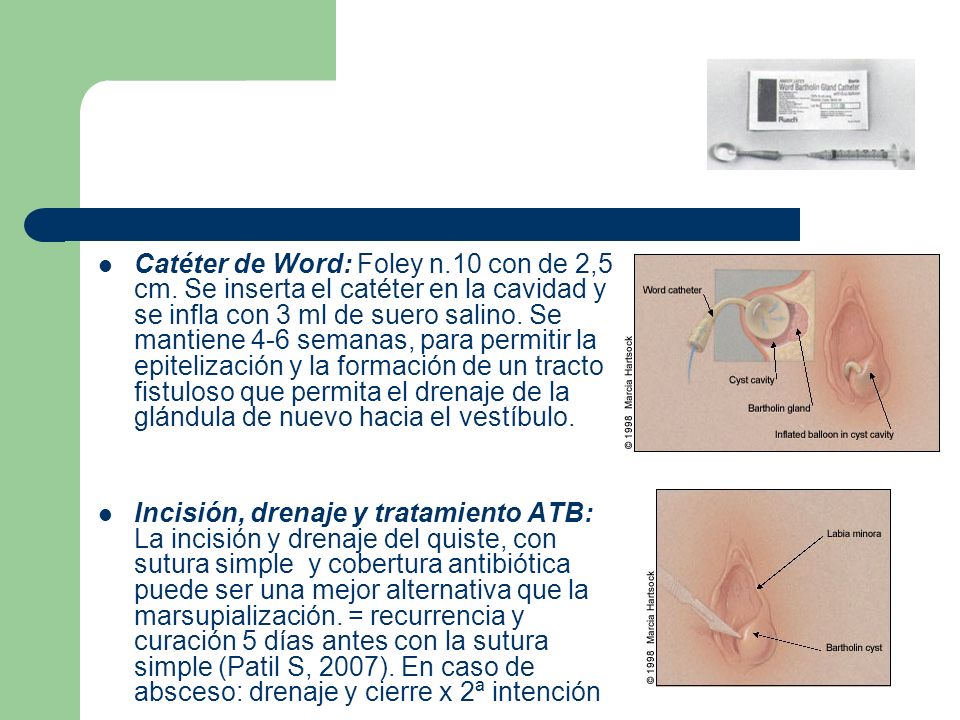 absceso de bartolino tratamiento antibiotico